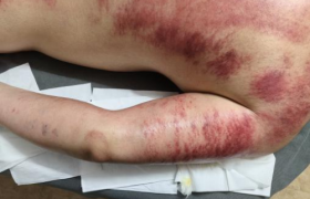 赵翌伊荣获拾遗传承“传统中医内病外治砭术诊疗法非物质文化遗产传承人”称号